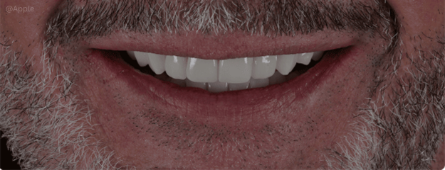 dental-implants-img