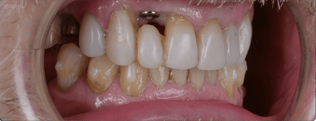 dental-implants-img