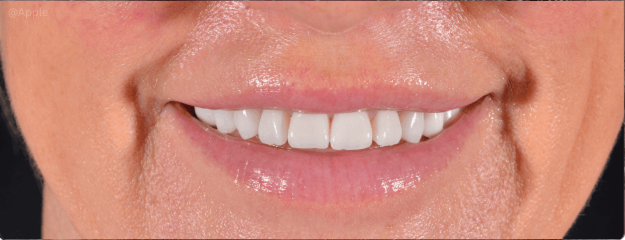 dental-implants-img