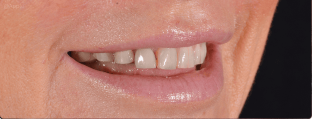 dental-implants-img
